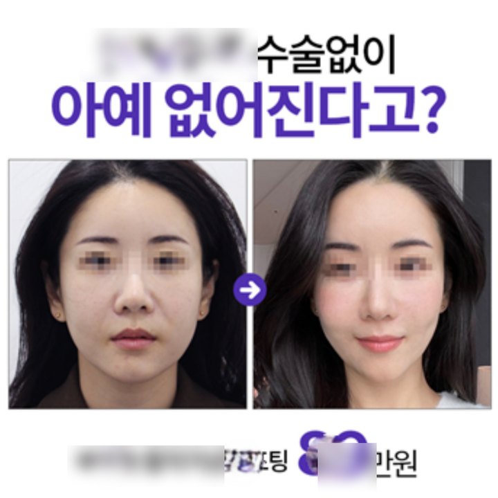 시술 전후 비교 광고